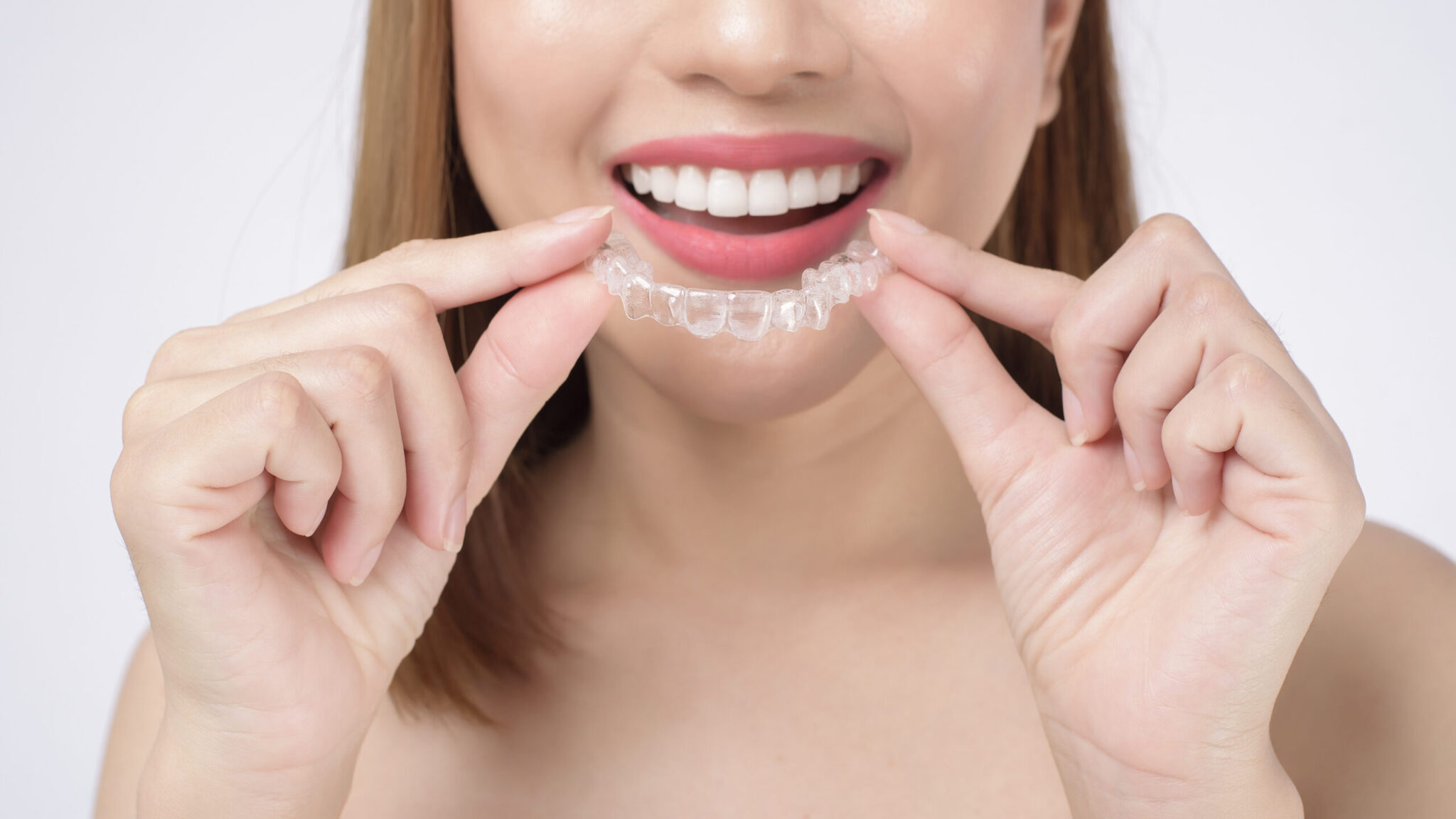 Todo lo que tienes que tener en cuenta de la ortodoncia Invisalign: la alternativa a la ortodoncia tradicional