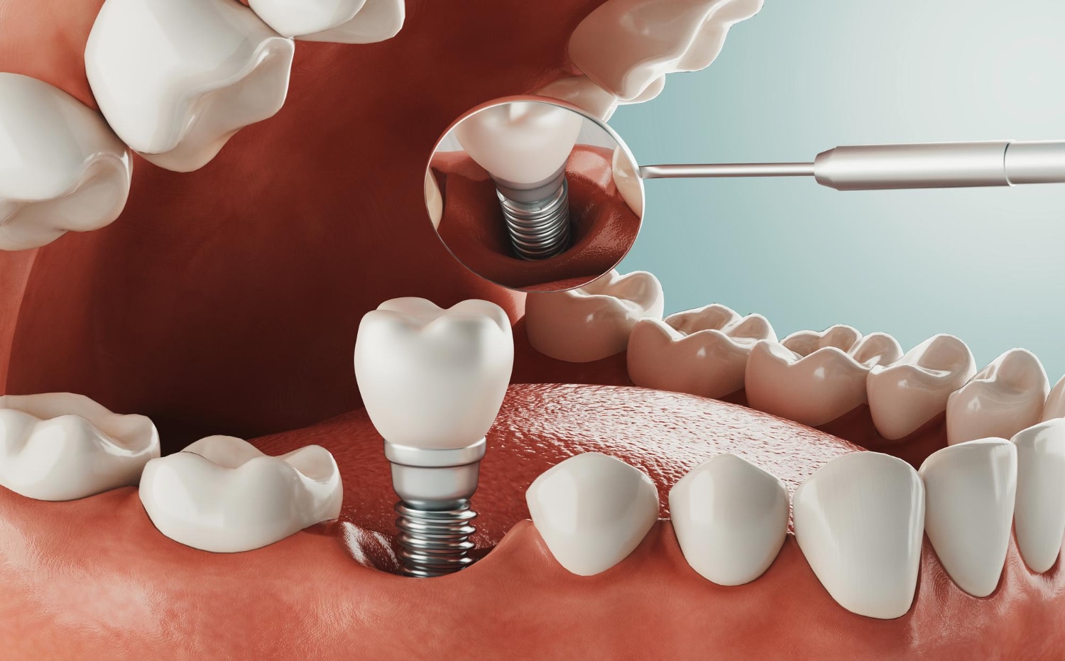 Implantes dentales: ¿quiénes son candidatos ideales y qué factores influyen en su elegibilidad?