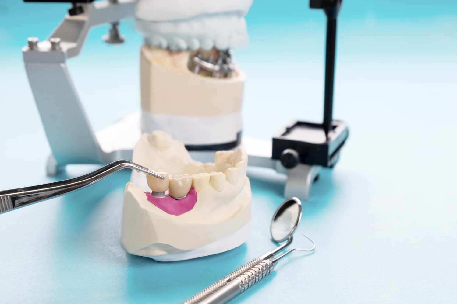Injerto de hueso en implantes dentales: todo lo que necesitas saber