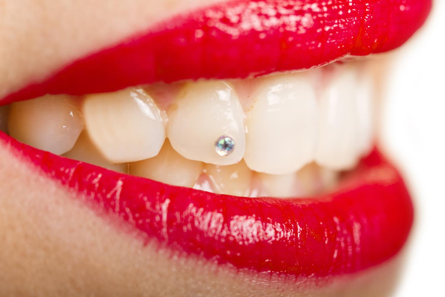 Joyería Dental: la tendencia estética que Ilumina tu sonrisa