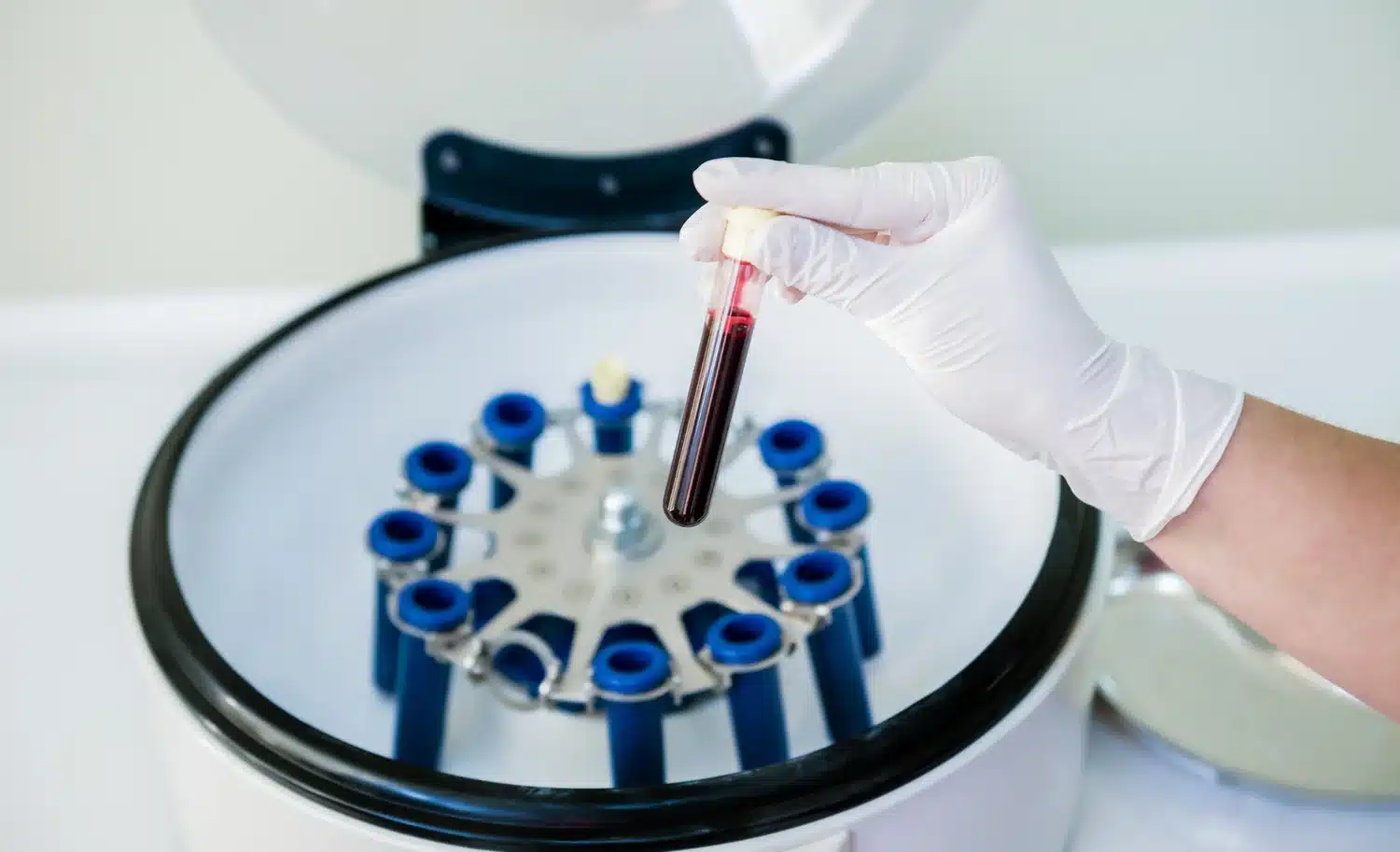 Tratamiento regenerativo con plasma en odontología: qué es y cuándo se recomienda