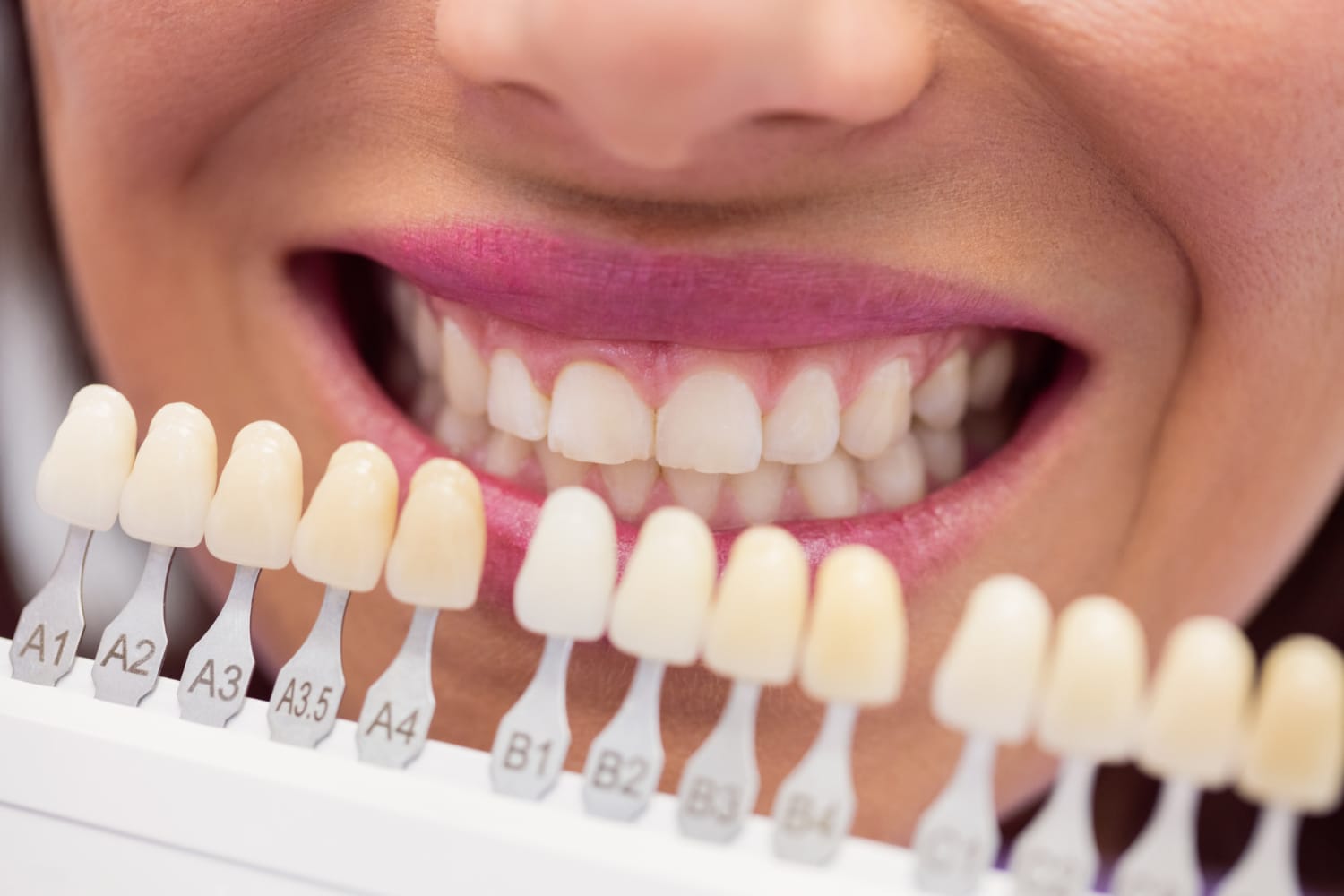 Carillas dentales: una solución estética para transformar la sonrisa