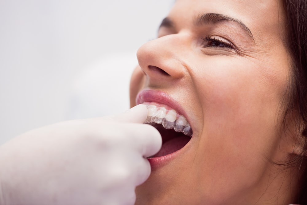 Ortodoncia invisible: Invisalign