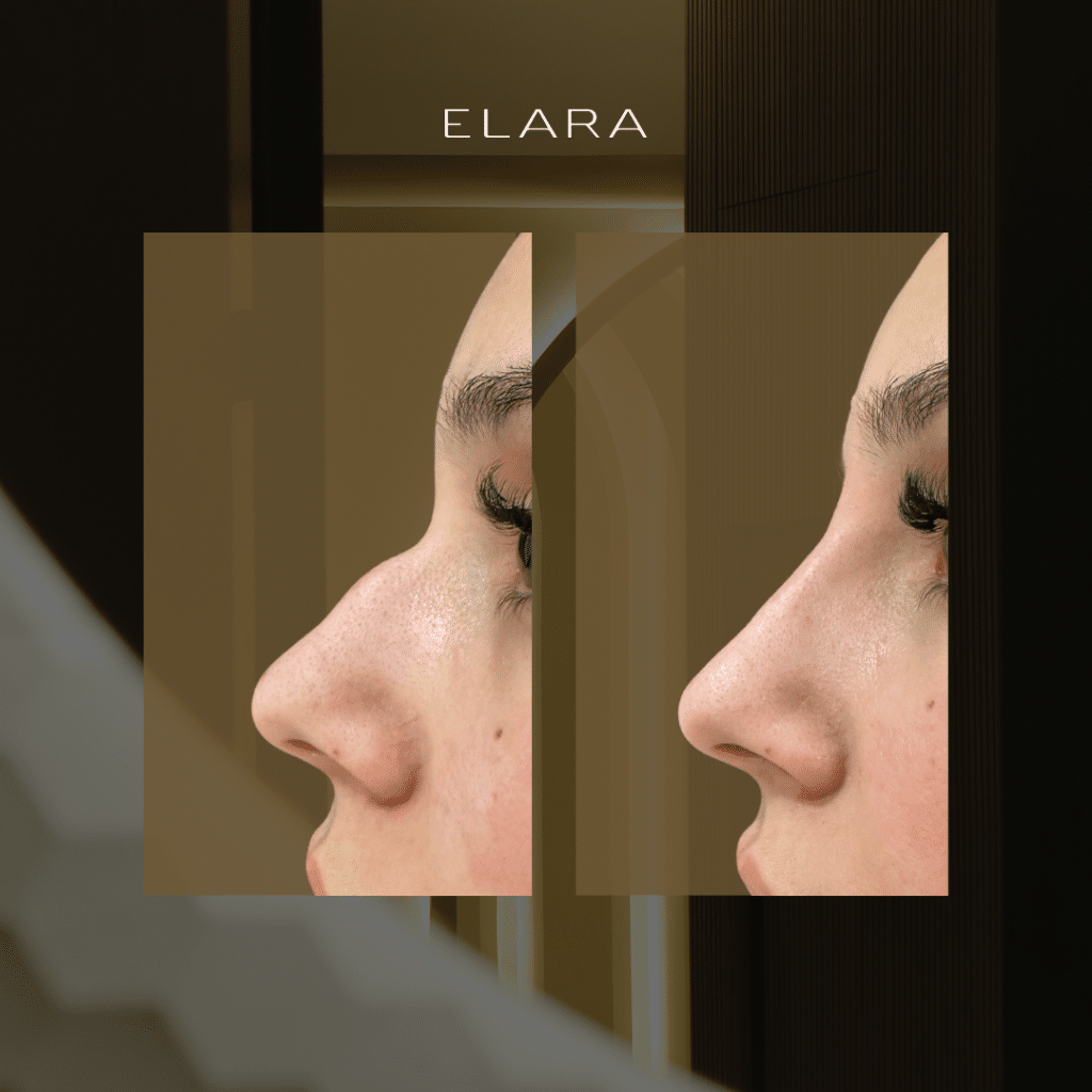 Rinomodelación: armonía facial sin cirugía