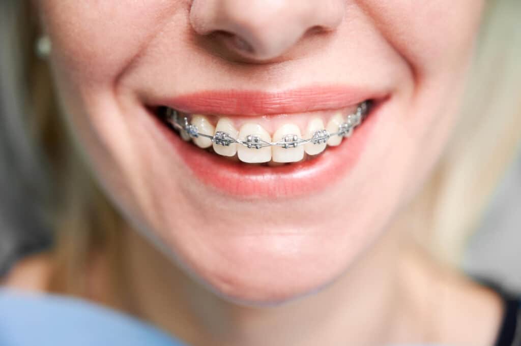 Ortodoncia: cómo mejorar la alineación dental y la salud de tu sonrisa