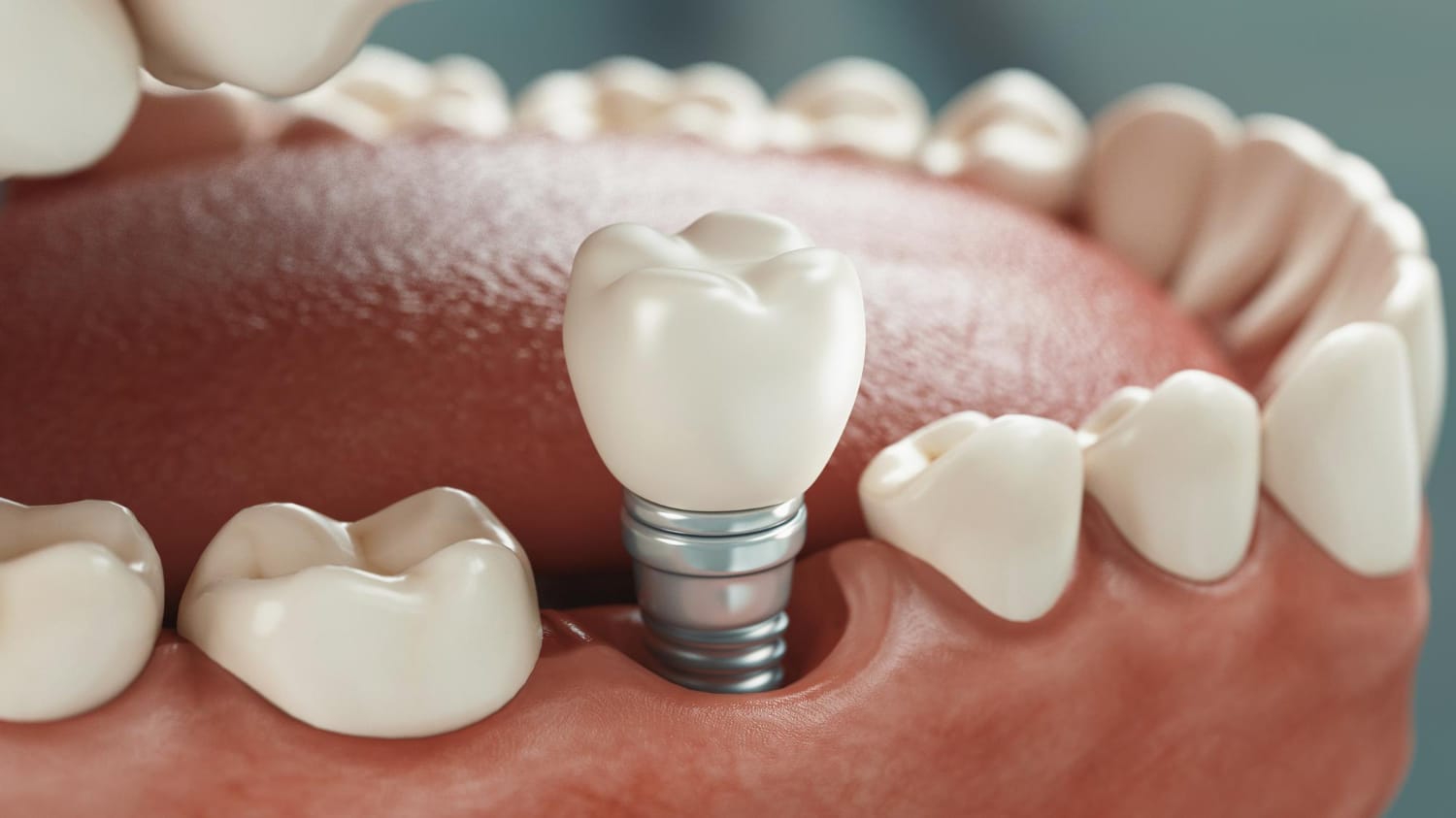 Implantes dentales en 2026: cuándo son necesarios y qué debes saber antes de decidirte
