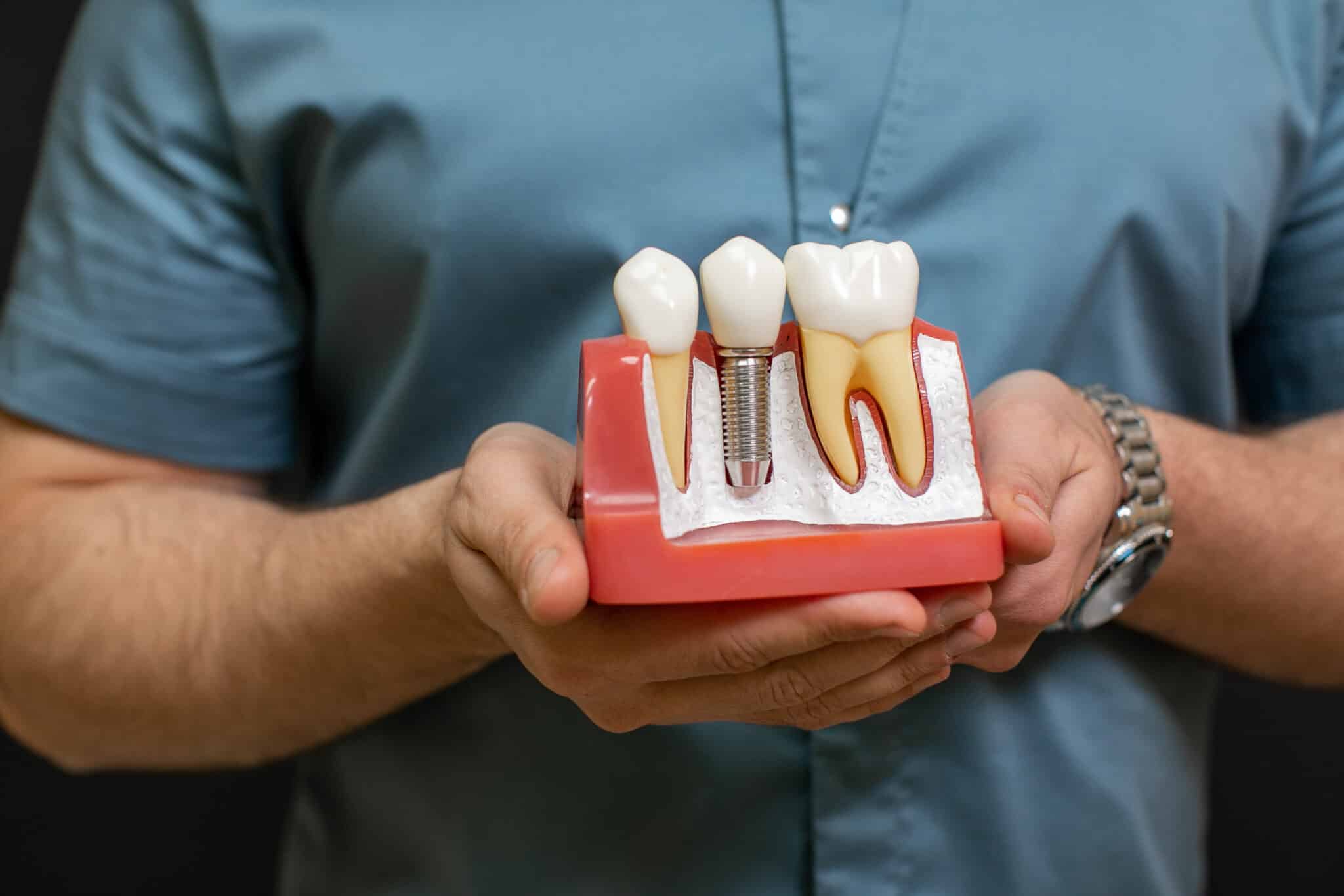 ¿Cuánto dura un implante dental y de qué depende su éxito?