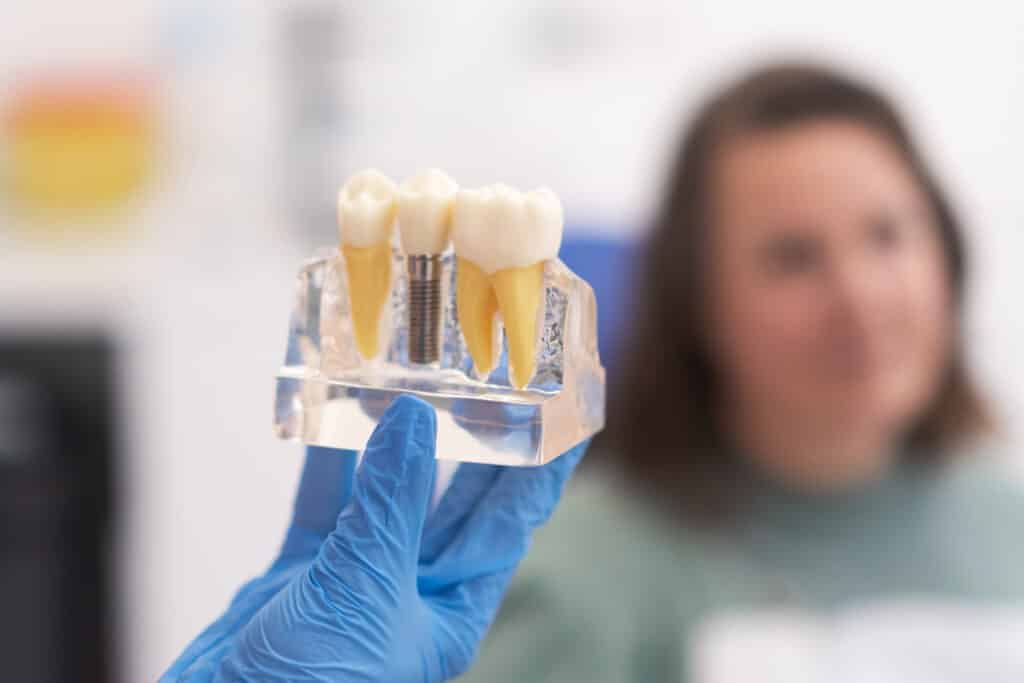 Cómo influyen los implantes dentales en el diseño de la sonrisa