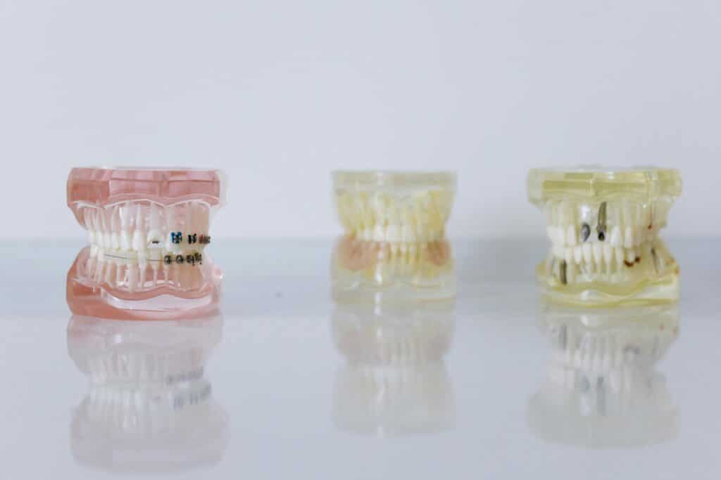Implantes Dentales: Guía Completa para una Sonrisa Perfecta y Natural