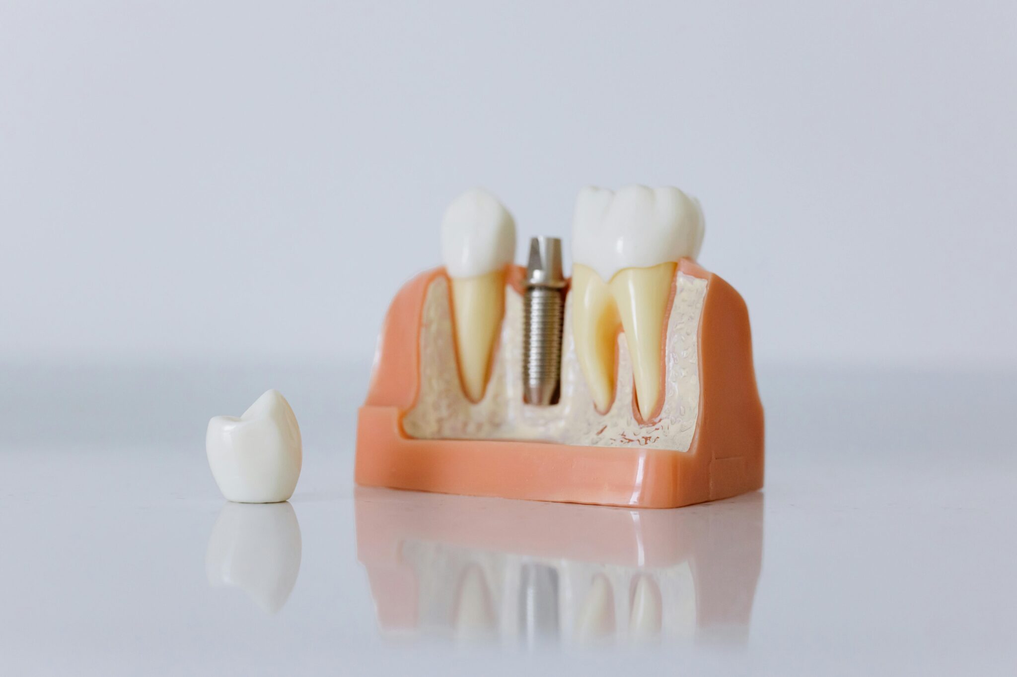 Implantes Dentales: Guía Completa para una Sonrisa Perfecta y Natural