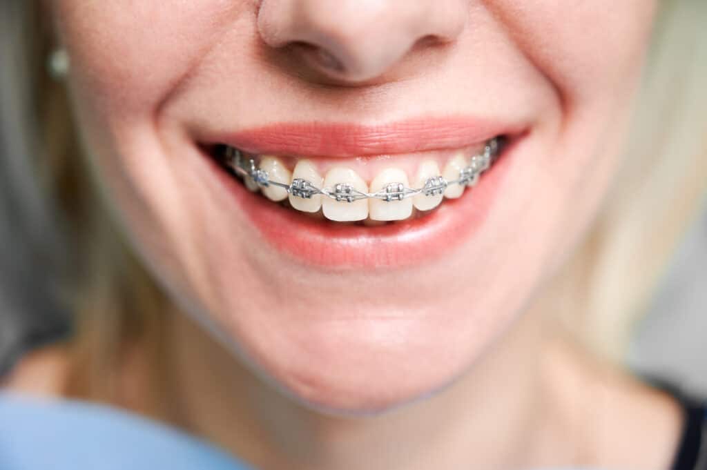 Ortodoncia para adultos: corrección de la sonrisa
