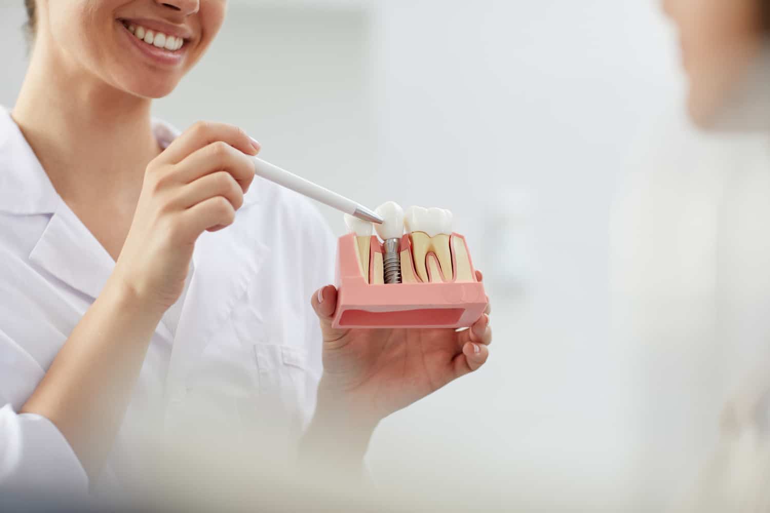 Implantes dentales: cuándo valorar esta solución y qué tener en cuenta