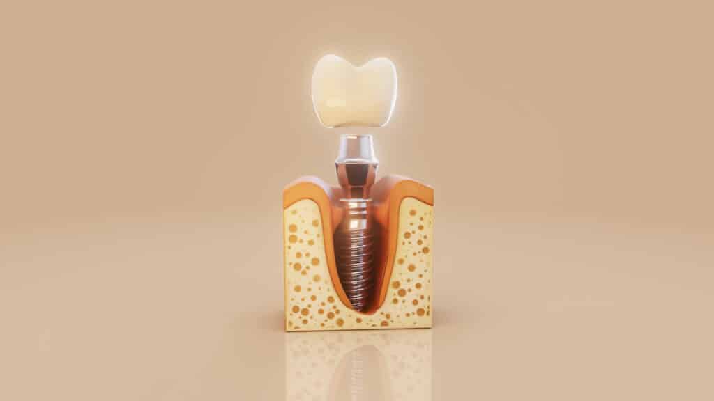 Implantes dentales: cuándo valorar esta solución y qué tener en cuenta